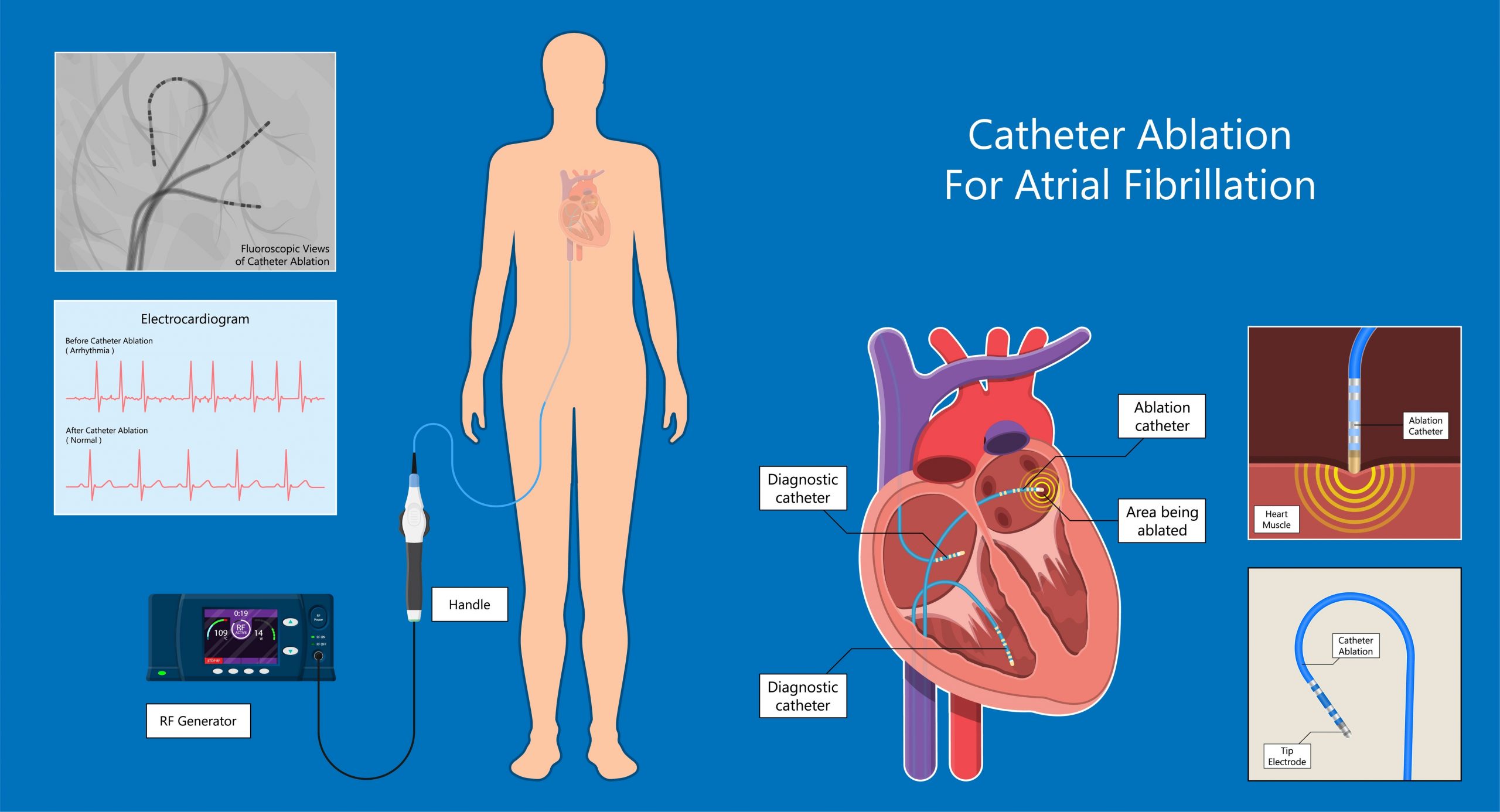 A medical illustration wih information about catheter ablation